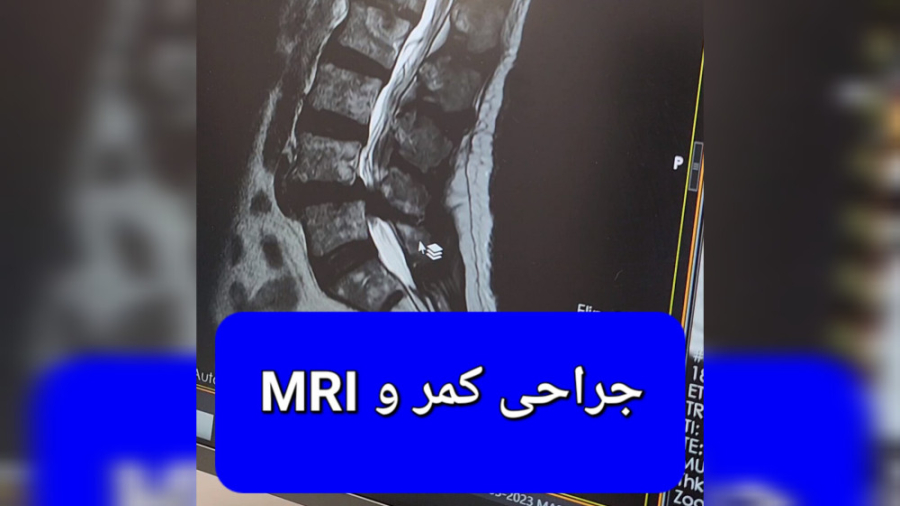 رابطه MRI و درمان تنگی کانال پرویز پرستویی