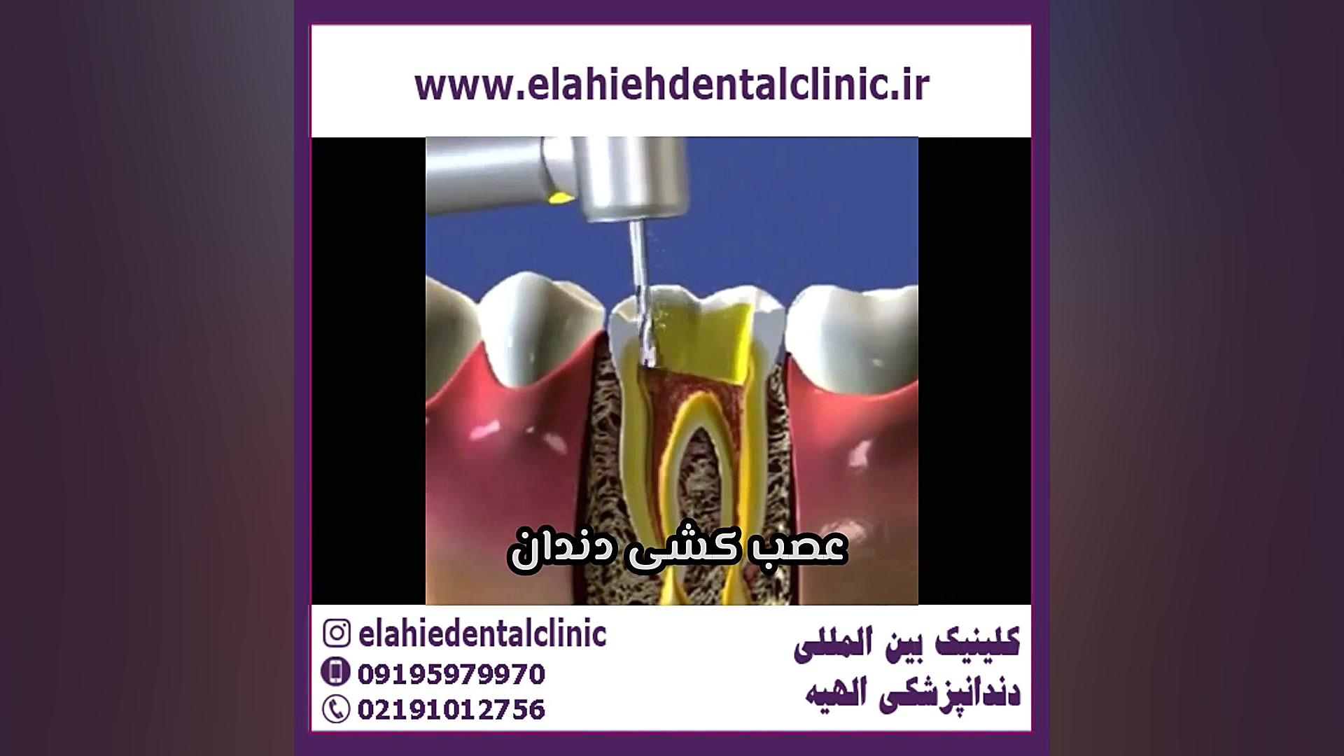 هزینه عصب کشی دندان با بیمه سلامت فیلم کوتاه
