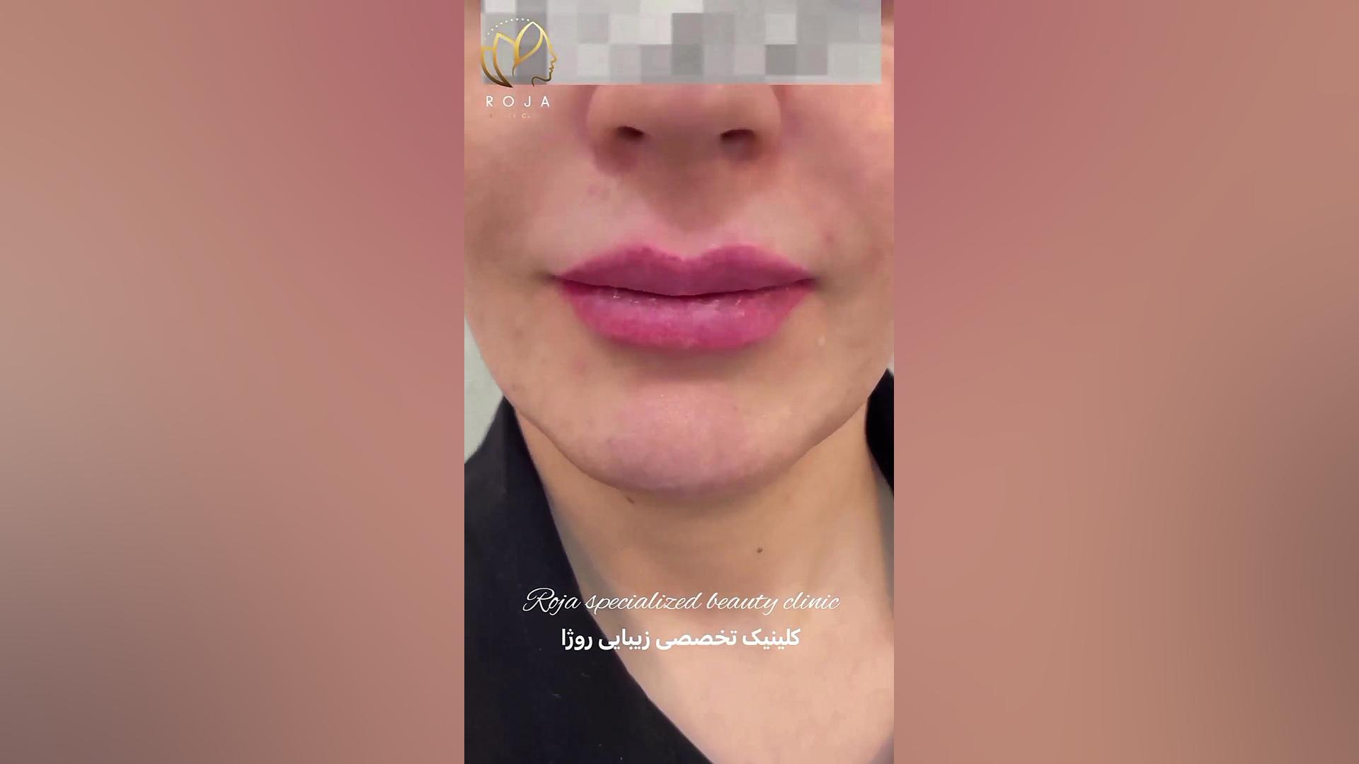 زاویه سازی صورت با فیلر/تزریق فیلر کلونیک اسپاسم