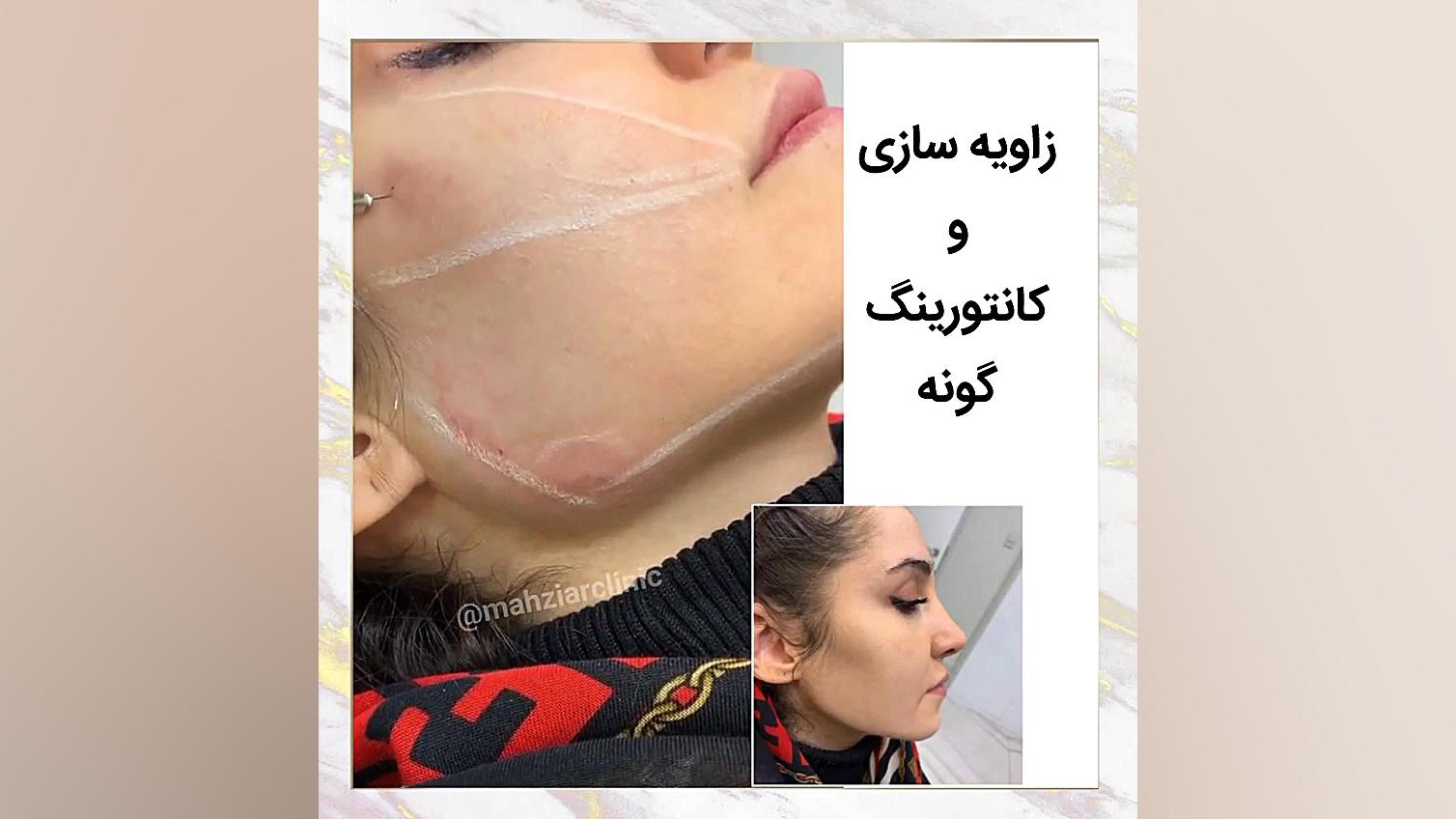 زاویه سازی صورت - کلینیک مهزیار بیولوژی پرتوی