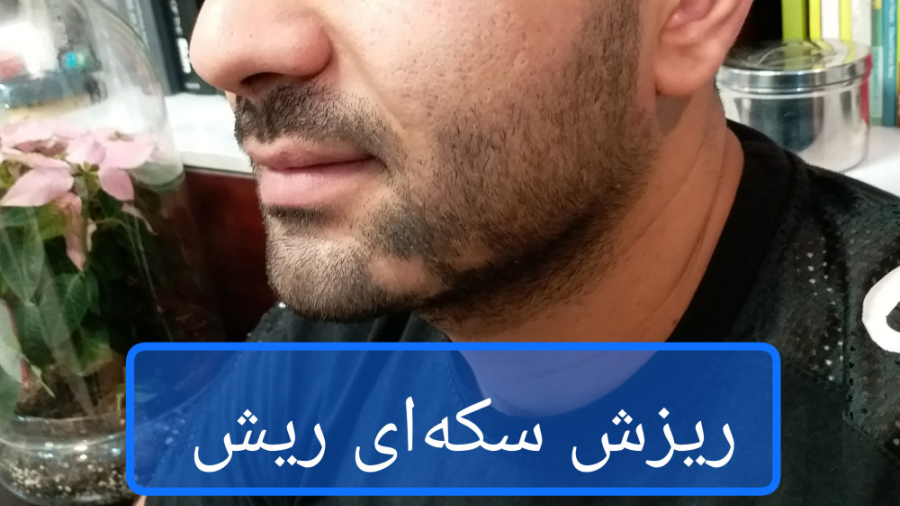 ریزش سکه ای ریش دکتر ریحانه مهرگان