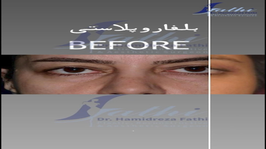جراحی همزمان بلفاروپلاستی و لیفت پیشانی دکتر حمید رضا فتحی فوق تخصص جراحی پلاستیک