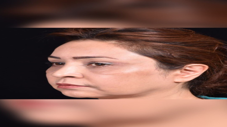 آندوسکوپی پیشانی و بلفاروپلاستی دکتر حمید رضا فتحی فوق تخصص جراحی پلاستیک