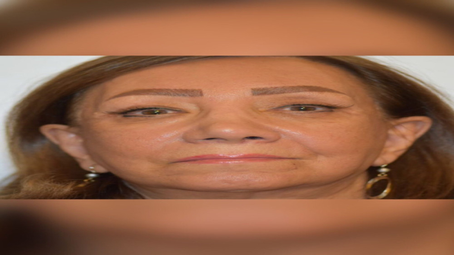 معجزه جراحی لیفت صورت دکتر حمید رضا فتحی فوق تخصص جراحی پلاستیک