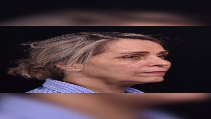 بلفاروپلاستی و جوانسازی صورت دکتر حمید رضا فتحی فوق تخصص جراحی پلاستیک