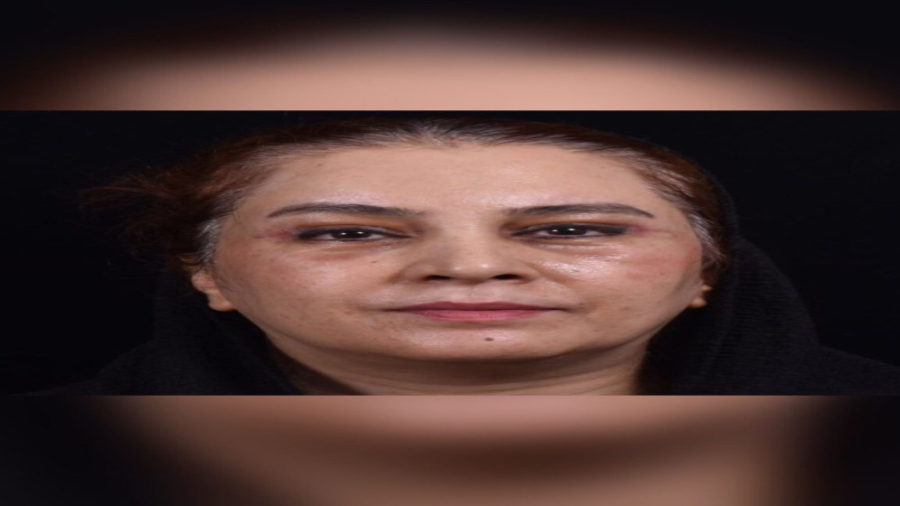 نتیجه عمل بلفاروپلاستی دکتر حمید رضا فتحی فوق تخصص جراحی پلاستیک