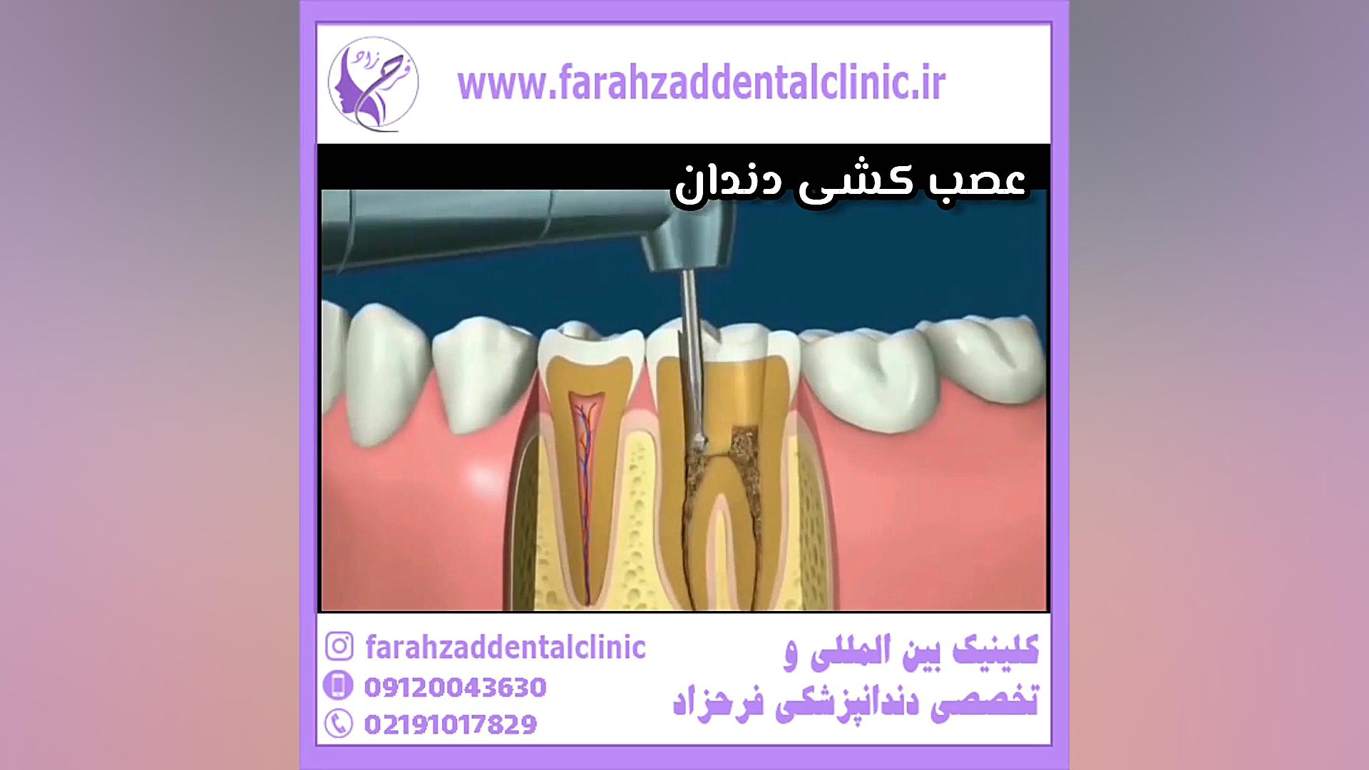 عصب کشی دندان لیزر کوانتومی جراحی چشم