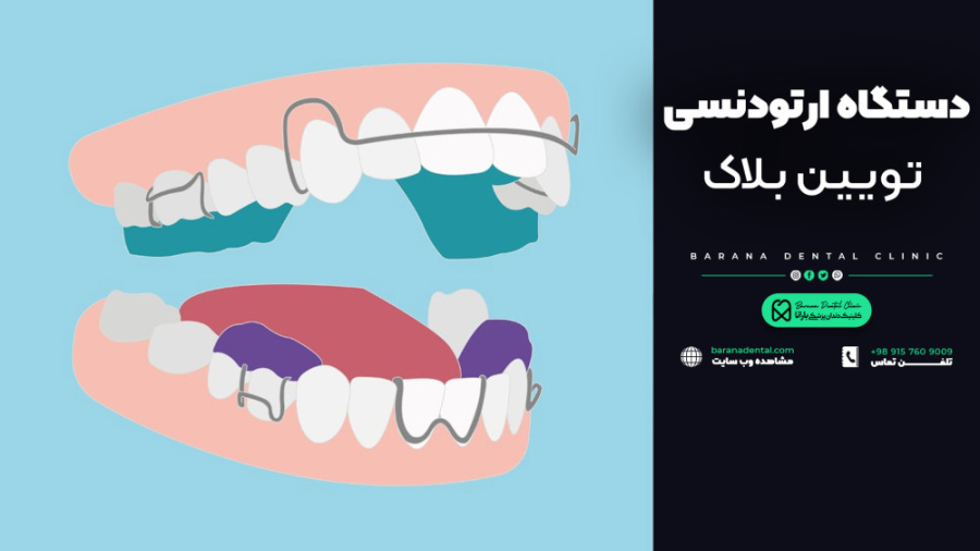 "نحوه استفاده از دستگاه ارتودنسی فانکشنال تویین بلاک" نوید محمدزاده