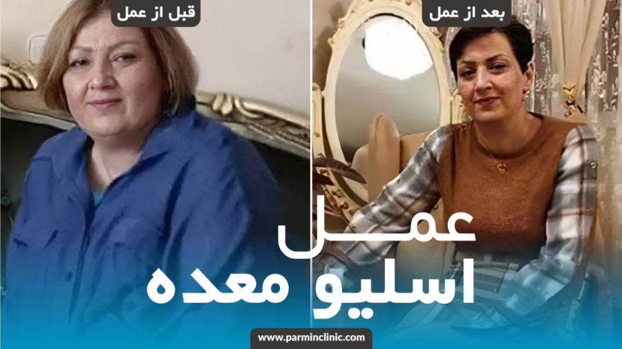 قبل و بعد از جراحی اسلیو معده توسط دکتر شاهین جمیلی در کلینیک زیبایی پارمین ماستوسیتوز