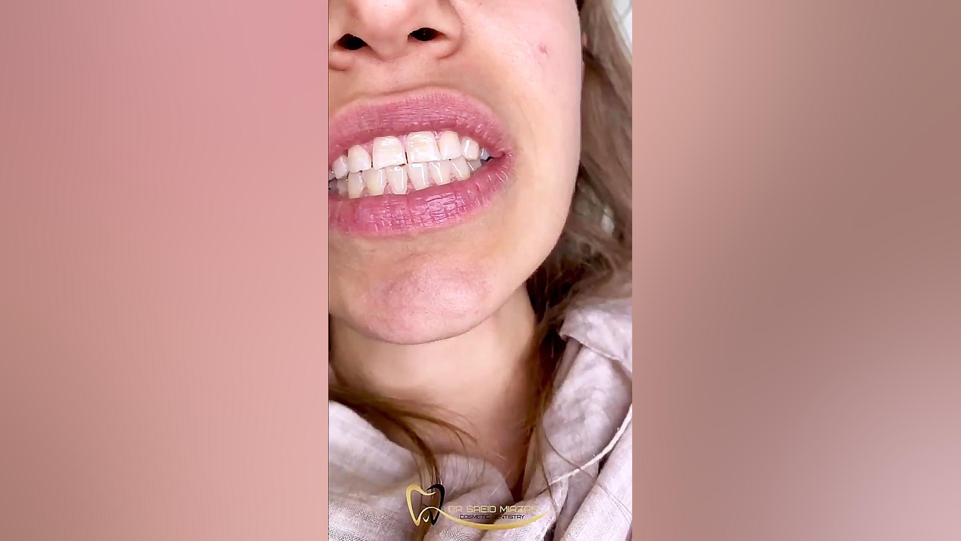 اصلاح طرح لبخند دستگاه آنالیز ایمیجینگ سلول زنده