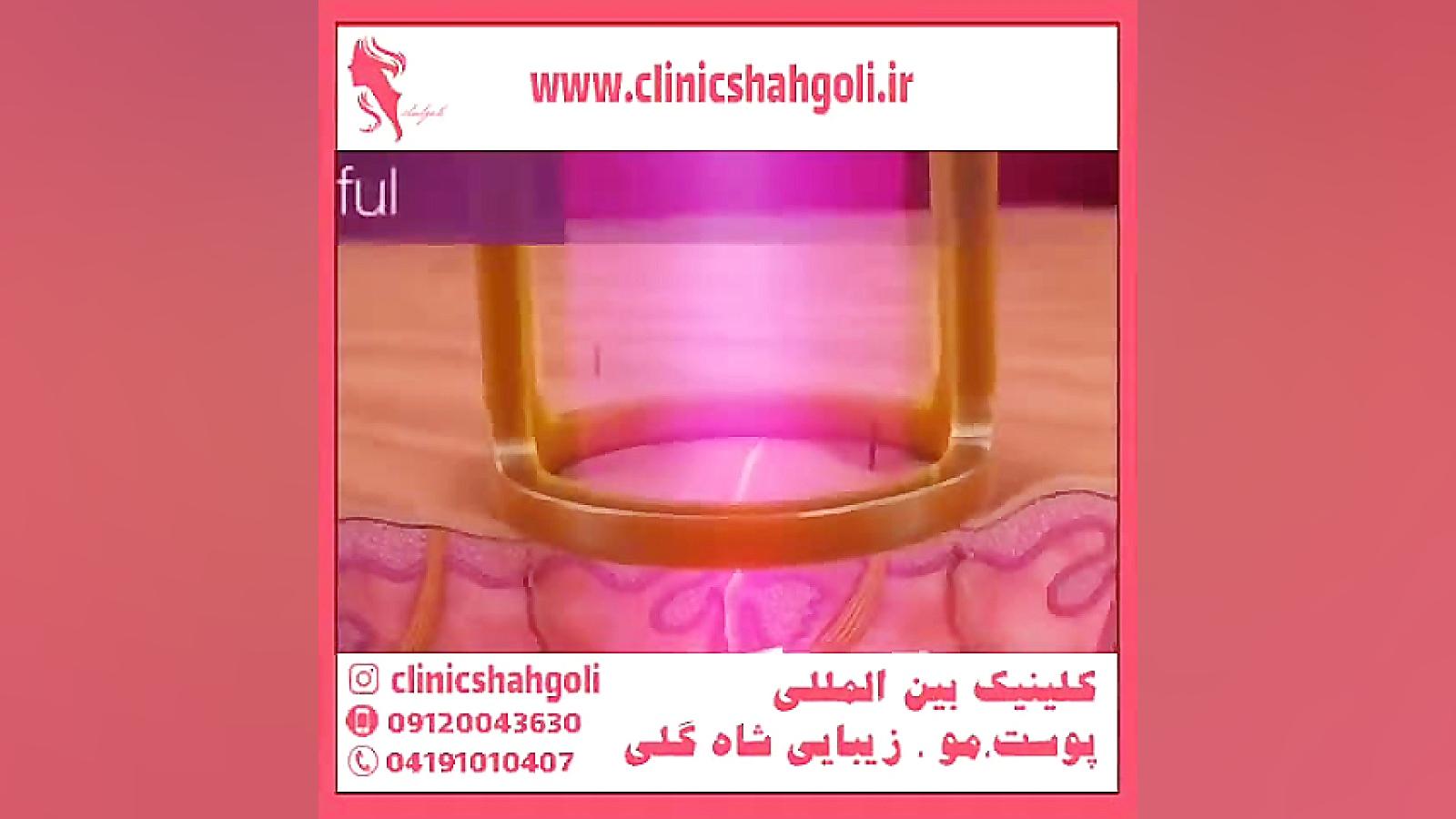 لیزر مو های زائد سندرم نفروتیک ارثی