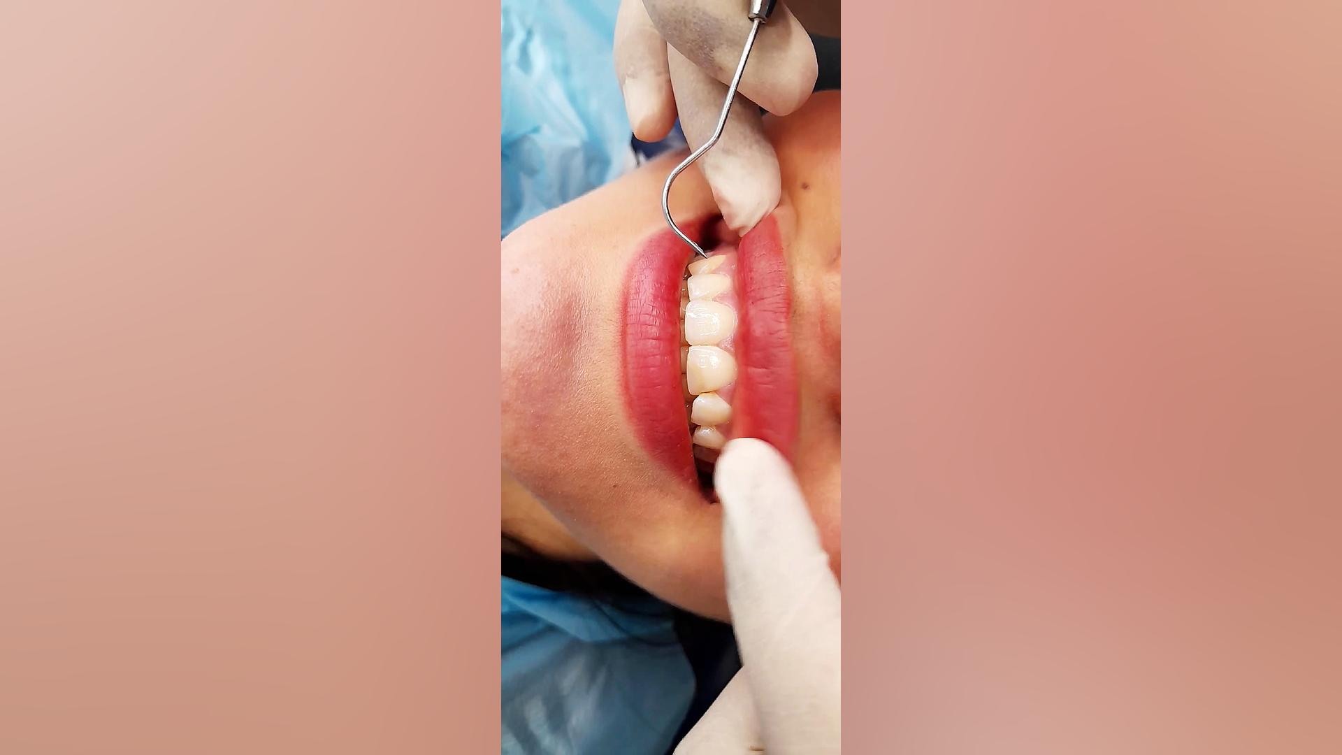 لیفت لثه و آماده شدن دندان برای کامپوزیت دندان کلینیک دندانپزشکی آرت دنتال دکتر شاکری