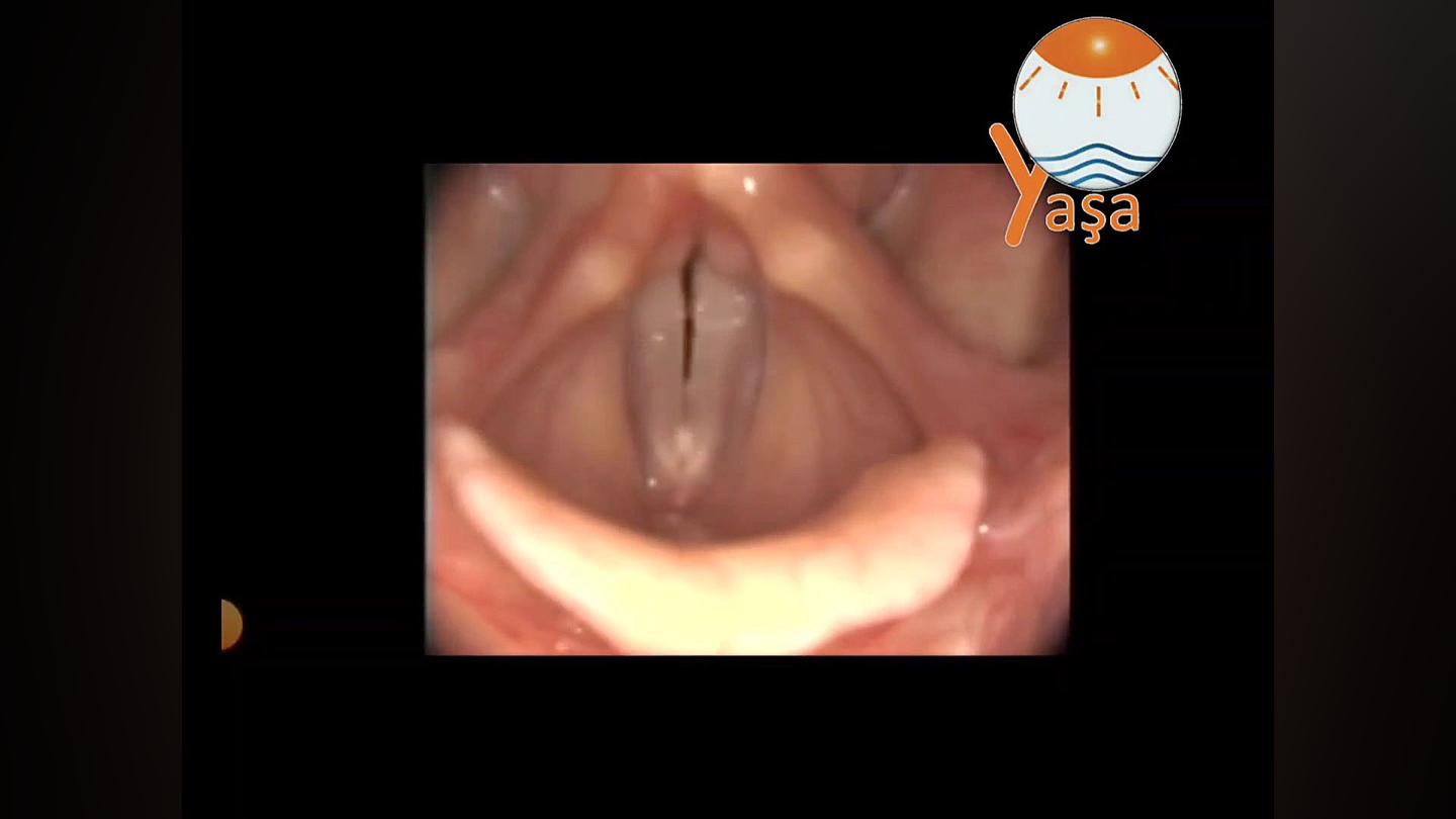 استروبوسکوپی حنجره و عکس برداری رنگی از حنجره در تبریز پیلینگ شیمیایی