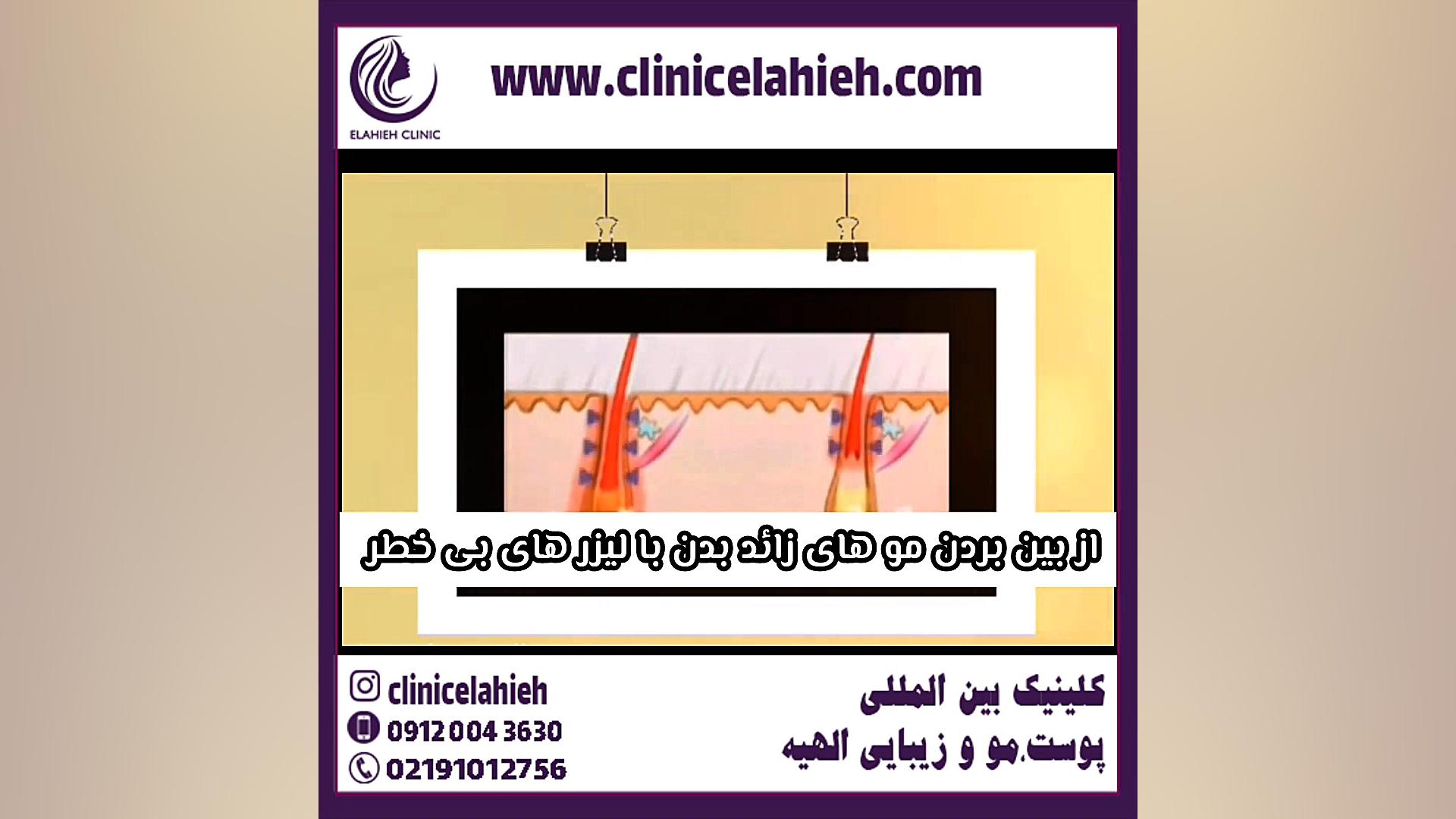 لیزر مو های زائد تست تنفس اوره C13