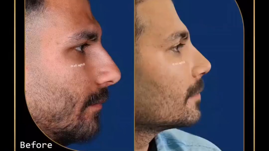 یک ماه بعد از جراحی زیبایی بینی دکتر علی عقیلی - جراح بینی در تهران