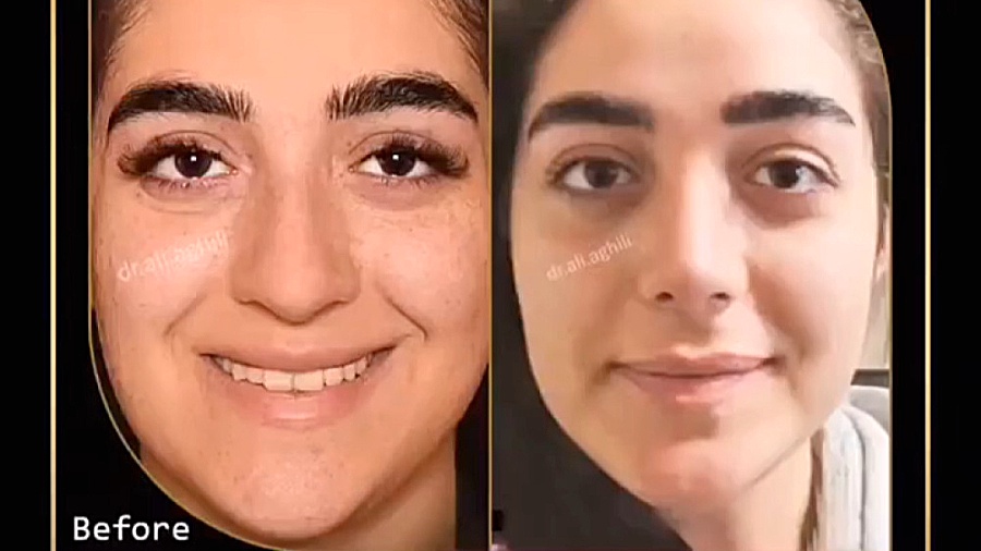بیست روز بعد از جراحی زیبایی بینی دکتر علی عقیلی - جراح بینی در تهران