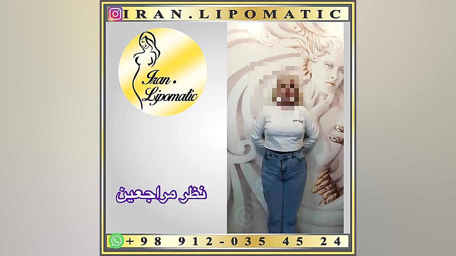 دکتر مروتی/ لیپوماتیک/ ترنسفر چربی به باسن/ ابدومینوپلاستی پزشکی شخصی‌سازی‌شده سطح یاخته‌ای