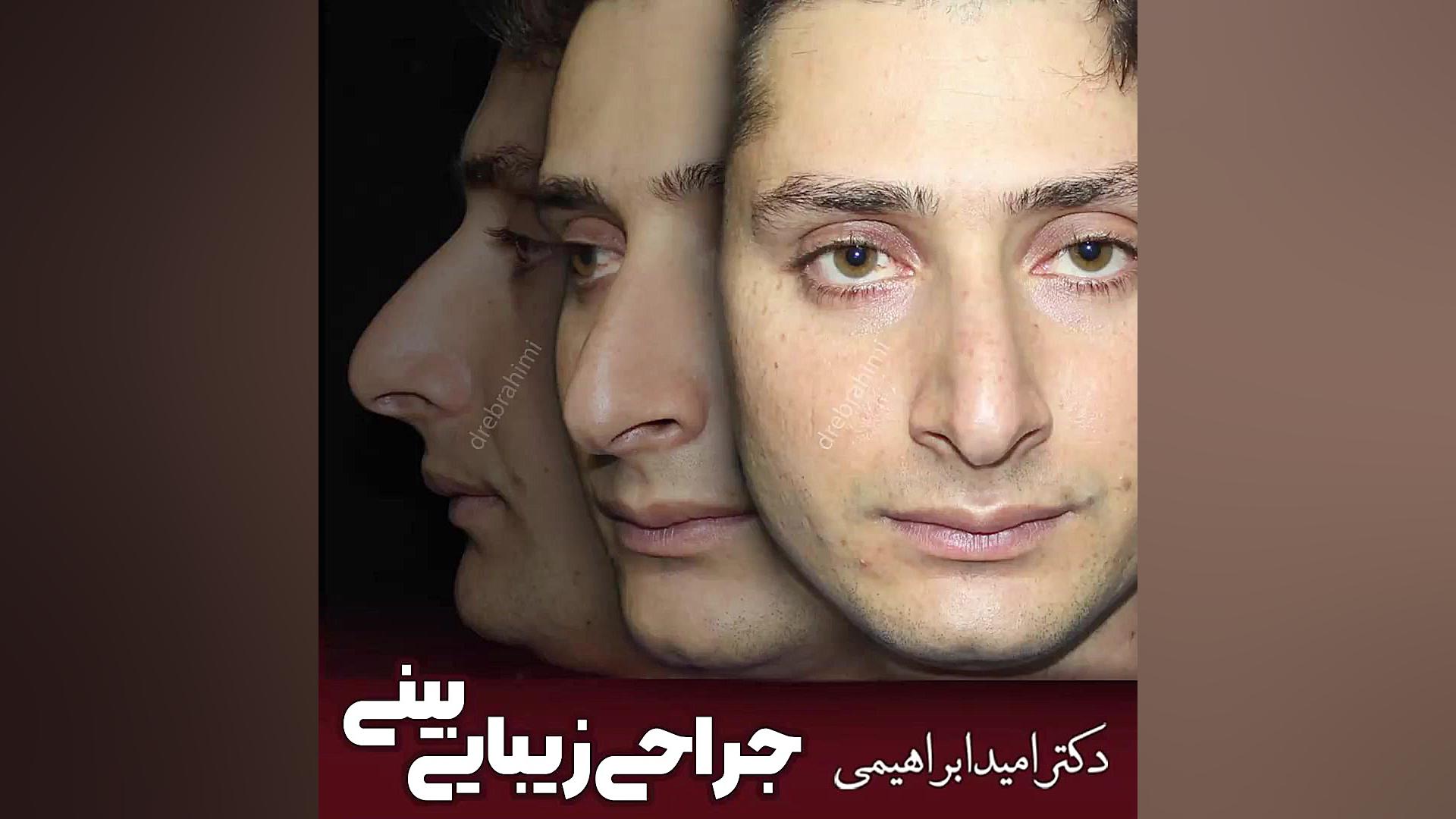 جراحی بینی مردانه طبیعی توسط دکتر امید ابراهیمی، بهترین جراح بینی طبیعی در تهران دکتر امید ابراهیمی