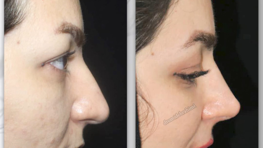 جراحی بینی گوشتی توسط دکتر امید ابراهیمی بهترین جراح بینی در تهران دکتر امید ابراهیمی