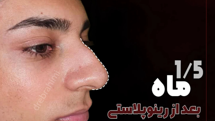 جراحی بینی طبیعی مردانه توسط دکتر امید ابراهیمی بهترین جراح بینی در تهران دکتر امید ابراهیمی