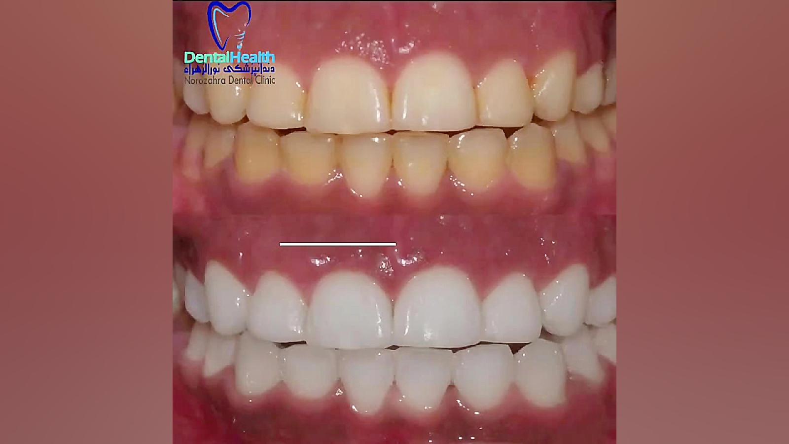 بلیچینگ دندان بیماری گلوکوزامینوگلیکان تجمعی