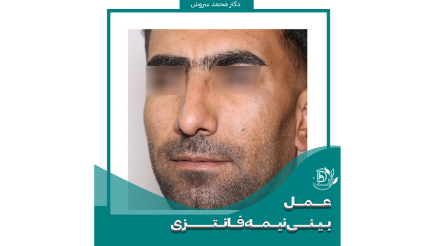 عمل بینی نیمه فانتزی توسط دکتر محمد سروش دکتر محمد سروش