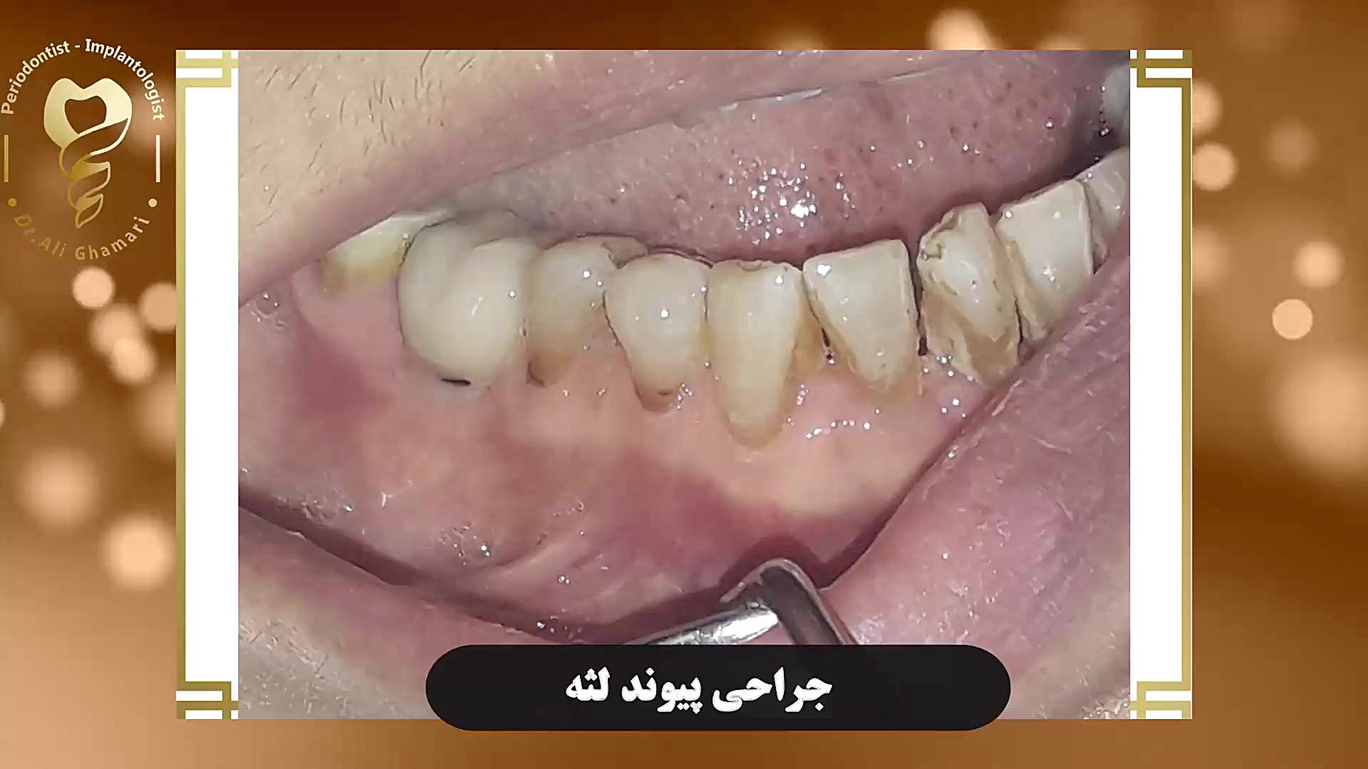 جراحی پیوند لثه دکتر علی قمری - متخصص جراحی لثه و ایمپلنت
