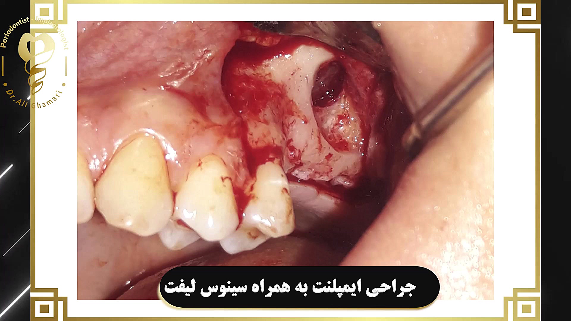جراحی ایمپلنت به همراه سینوس لیفت دکتر علی قمری - متخصص جراحی لثه و ایمپلنت