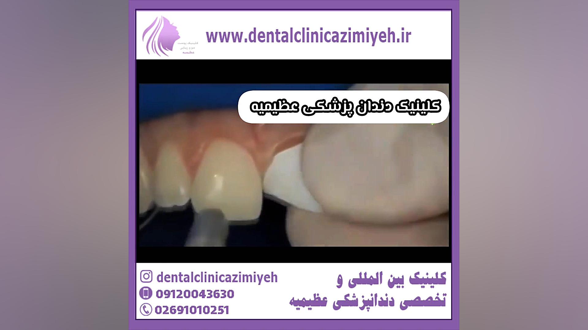 دندان شکسته چگونه ترمیم میشود DLCO