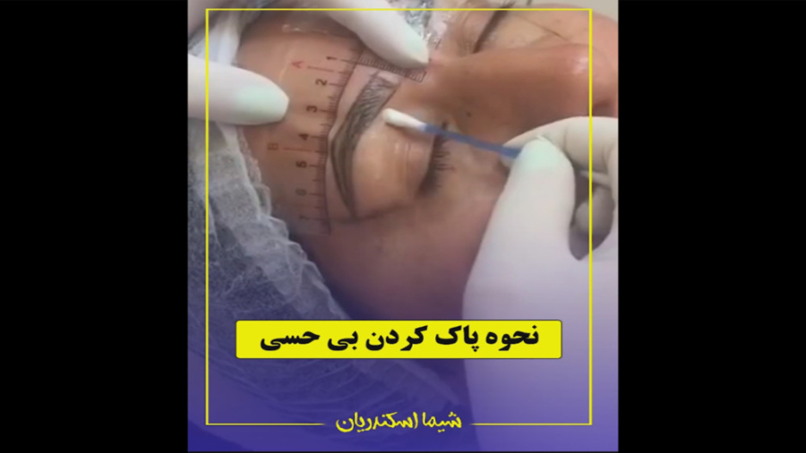 نحوه پاک کردن بی حسی