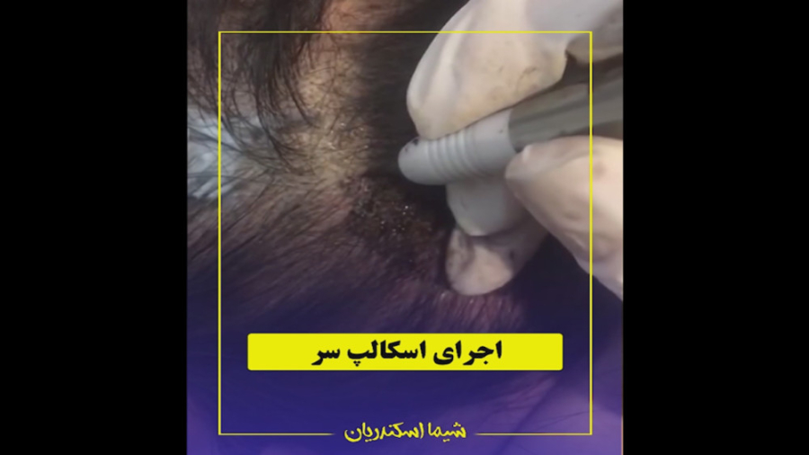 اجرای اسکالپ سر