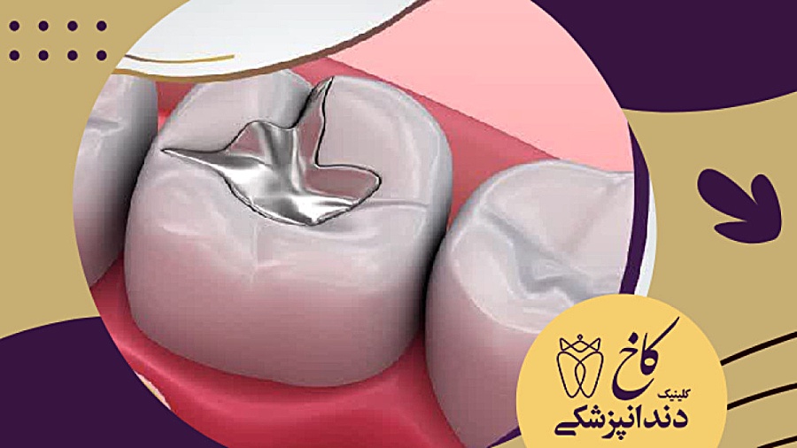 ترمیم دندان (پر کردن) دستگاه چاپ زیستی سه‌بعدی