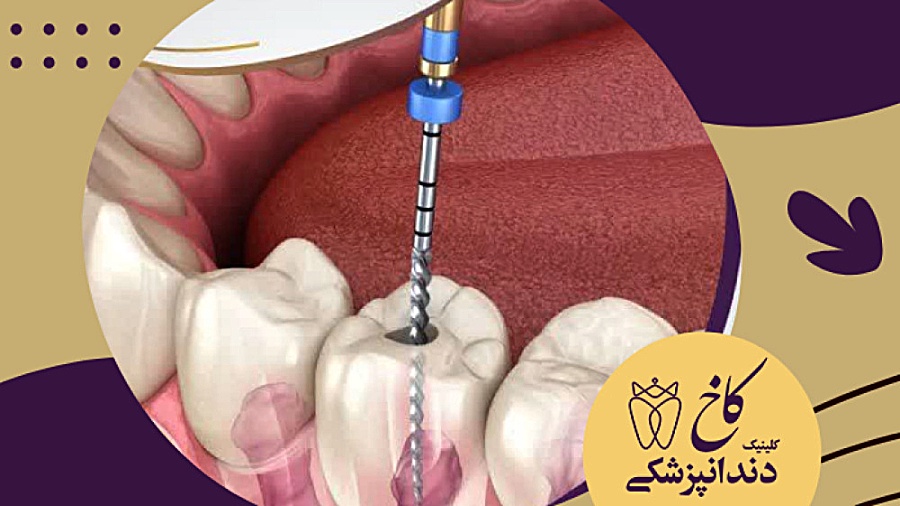 درمان ریشه دندان(عصب کشی) کلینیک دندانپزشکی کاخ