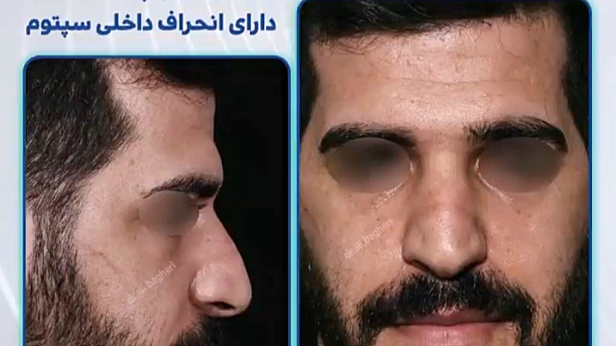جراحی بینی با پوست ضخیم و انحراف استخوان سپتوم دکتر علی باقری حق