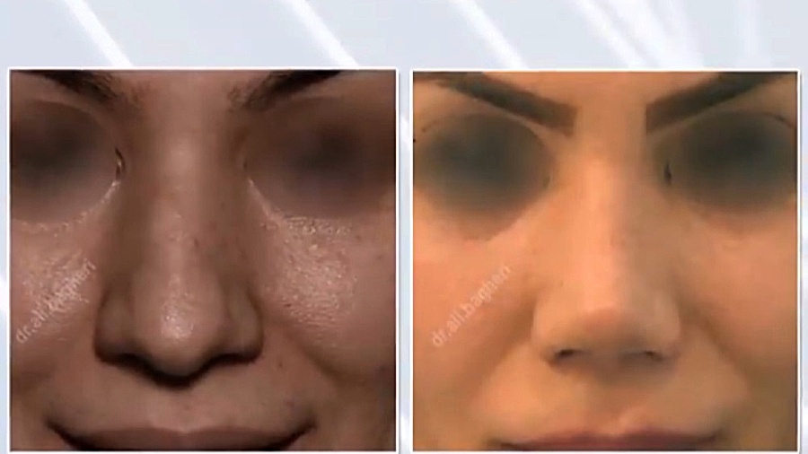 جراحی زیبایی بینی گوشتی دکتر علی باقری حق