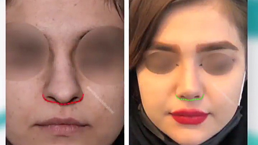 قبل و بعد جراحی زیبایی بینی دکتر علی باقری حق