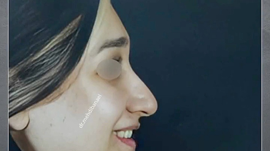 نتیجه چهار ماه بعد از جراحی بینی