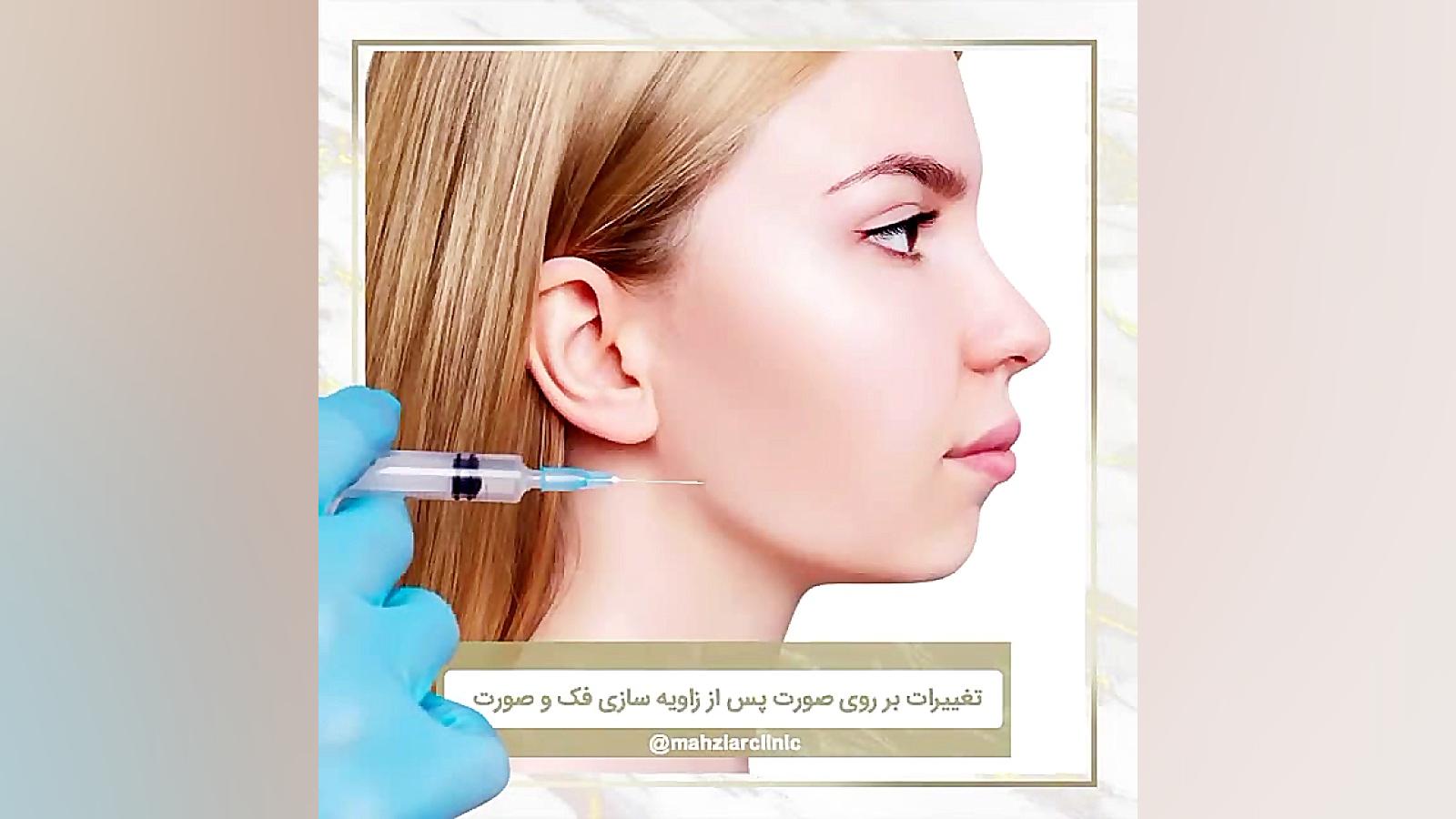 تاثیر تزریق فیلر بر زاویه سازی صورت - کلینیک مهزیار ANA