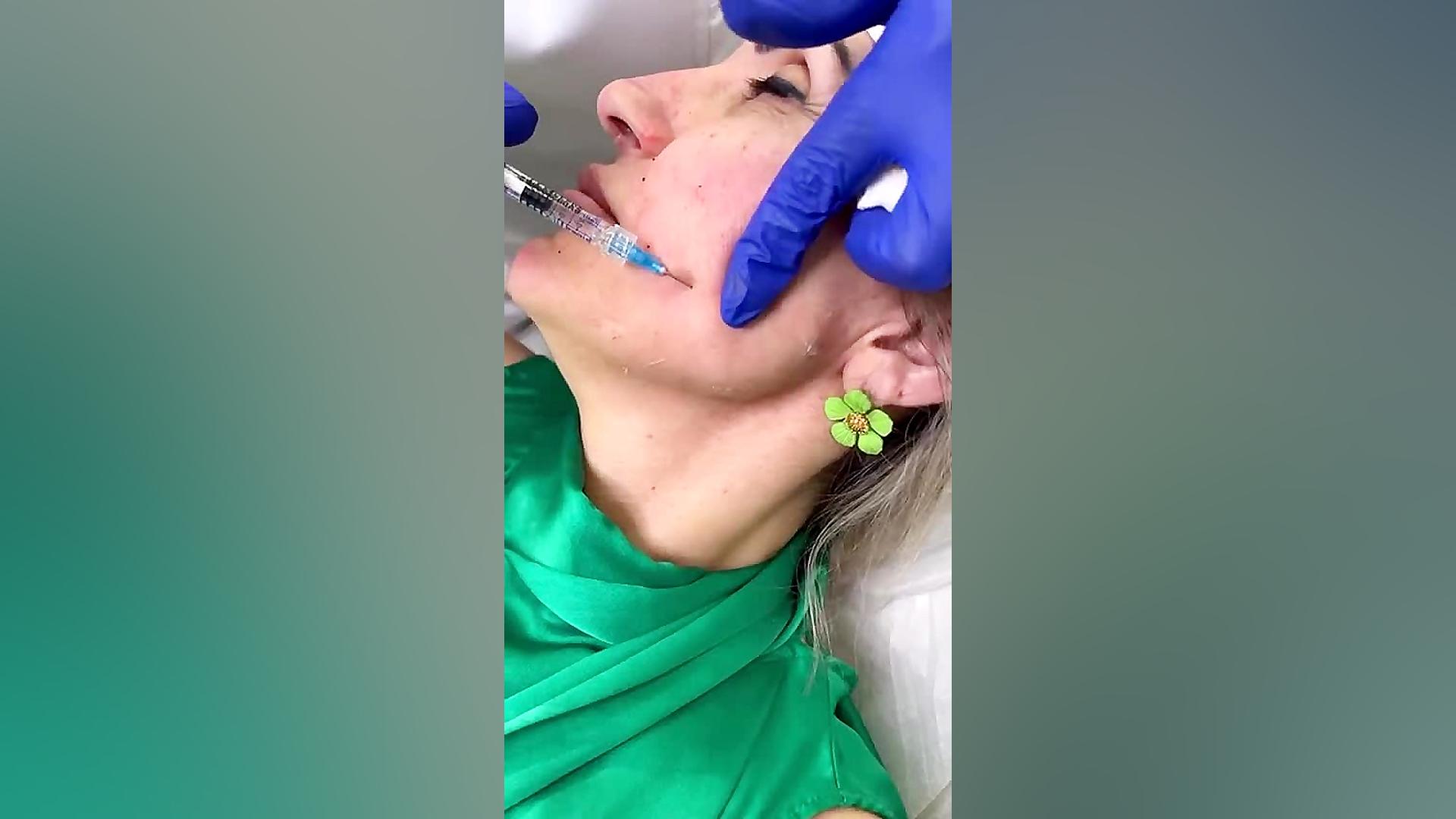 تزریق فک برای زاویه سازی صورت - کلینیک صورت پیلینگ شیمیایی