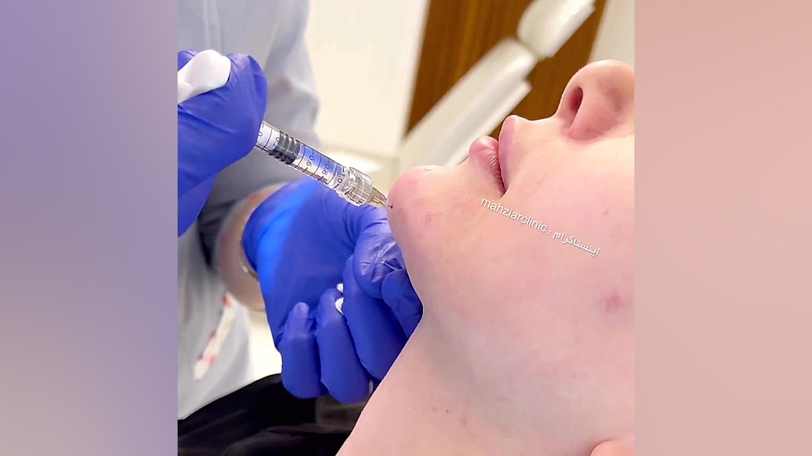 زاویه سازی صورت - کلینیک مهزیار ایلوبامید