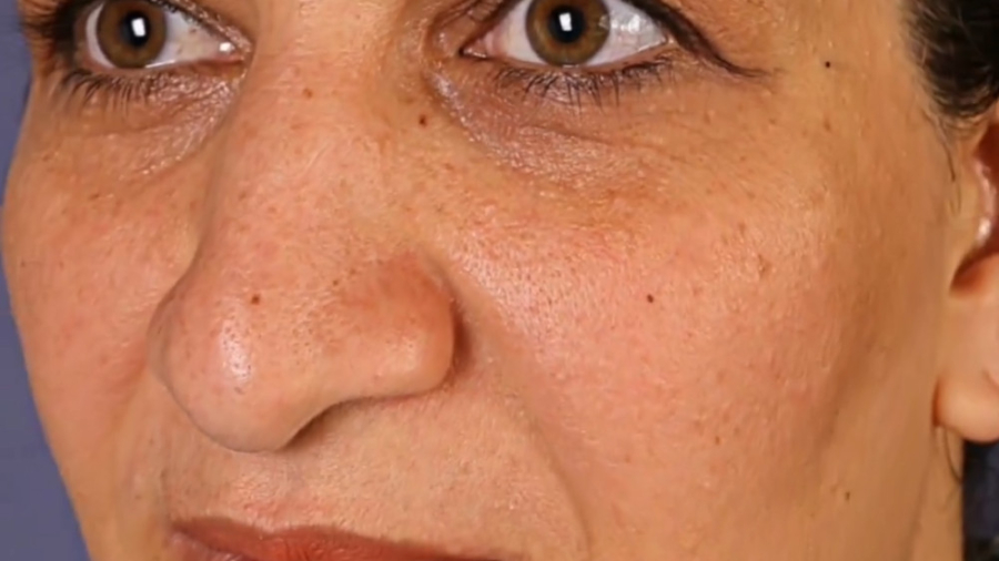 جراحی بینی عقابی دکتر جواد رحمتی