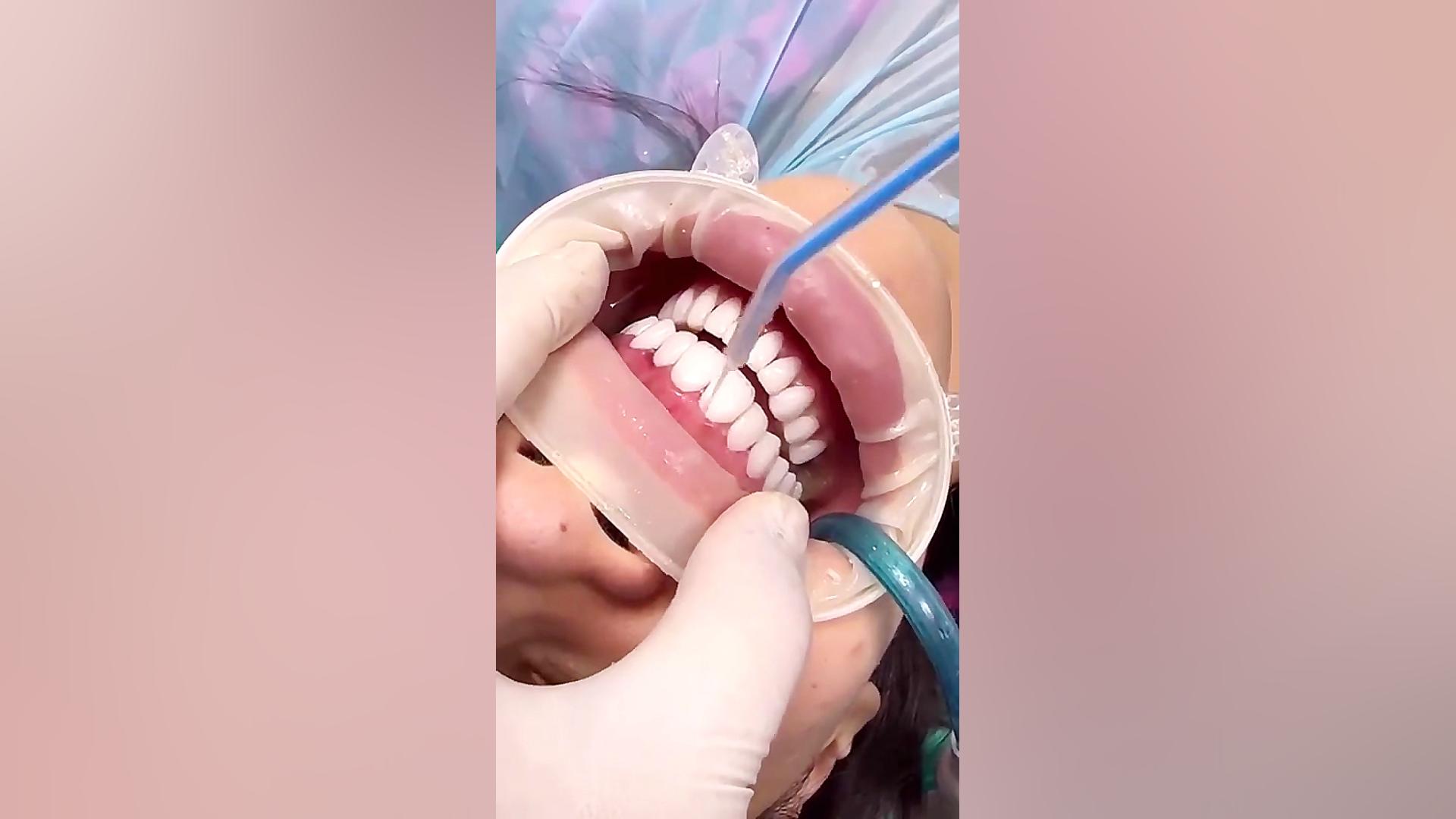 فیلم لمینت سرامیکی دندان دندانپزشکی زیبایی دکتر قاسم نژاد