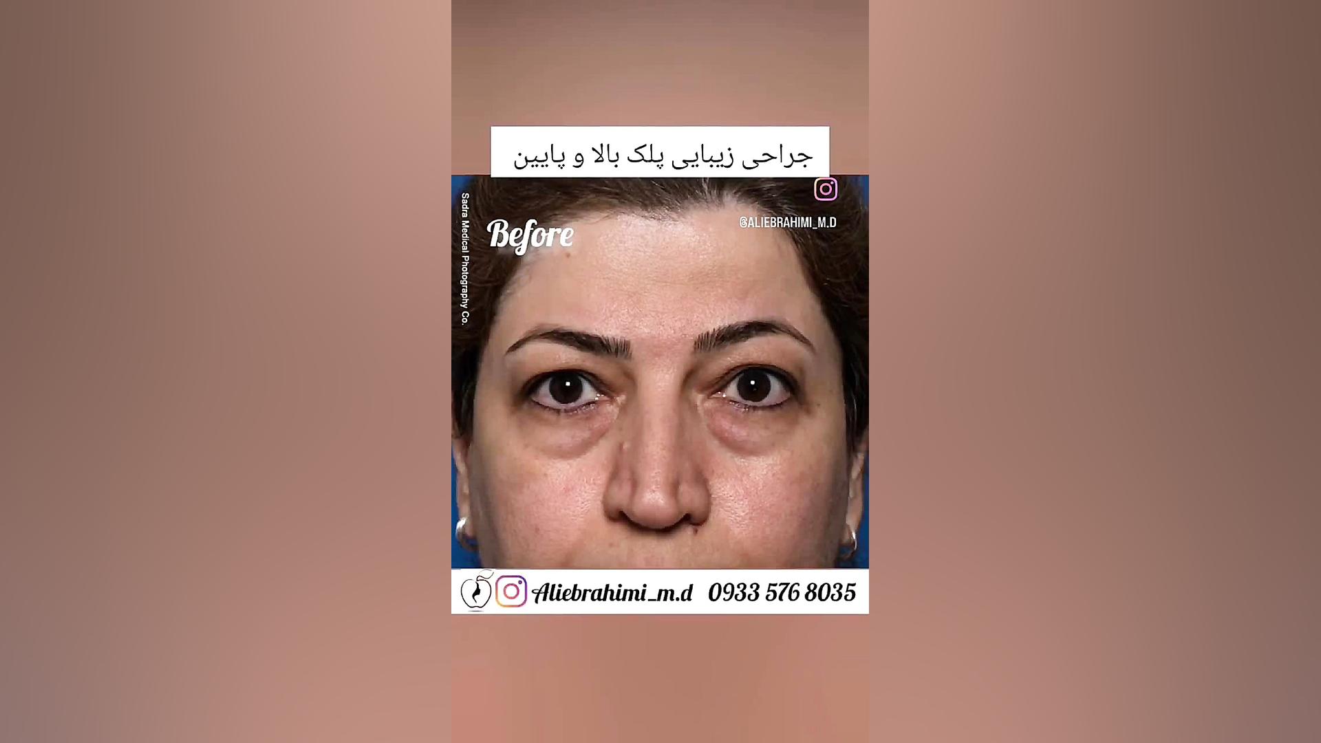 جراحی زیبایی پلک (بلفاروپلاستی) دکتر علی ابراهیمی فوق تخصص جراحی پلاستیک .