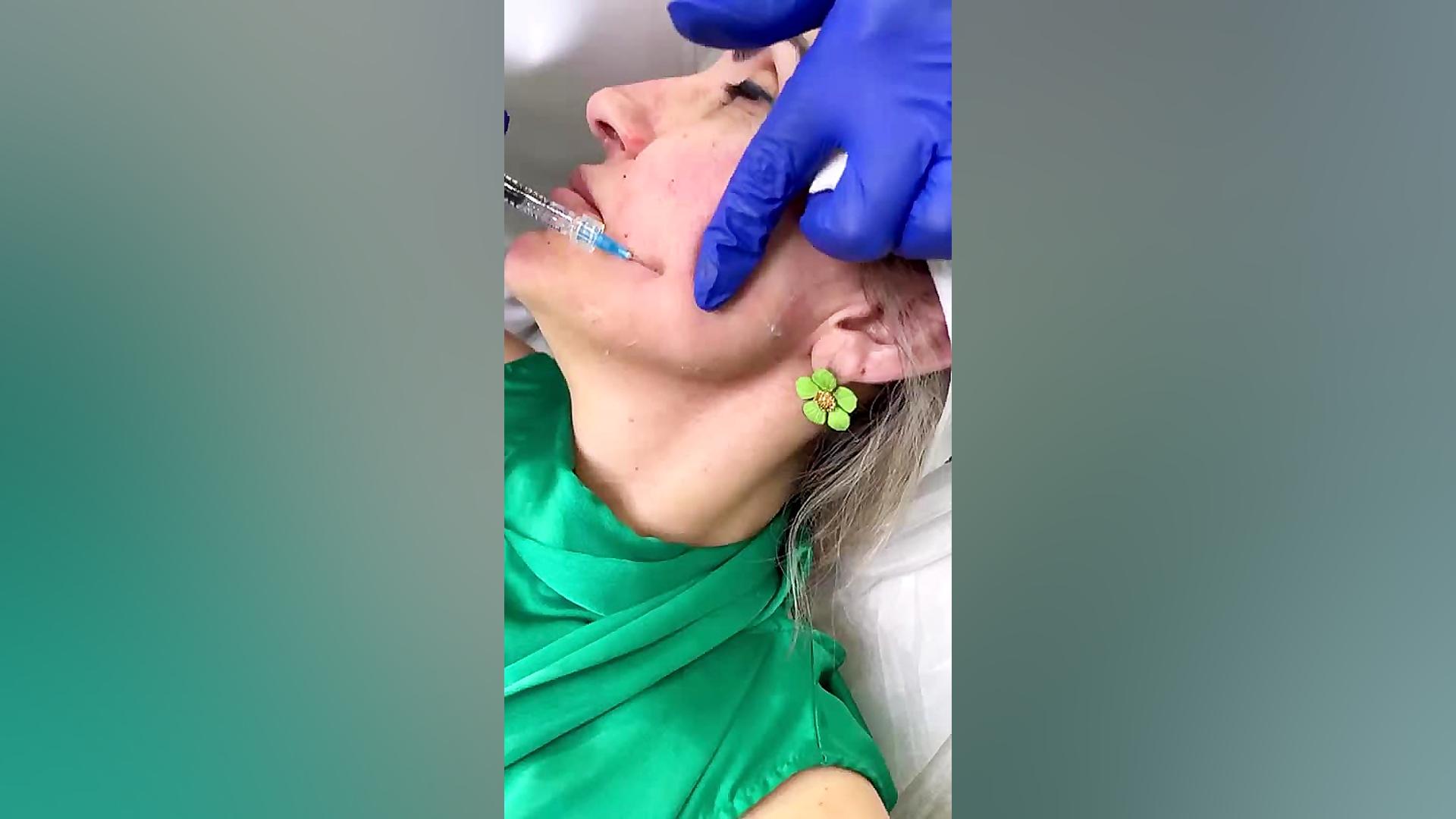 تزریق و زاویه سازی صورت - کلینیک مهزیار جم‌سیتابین