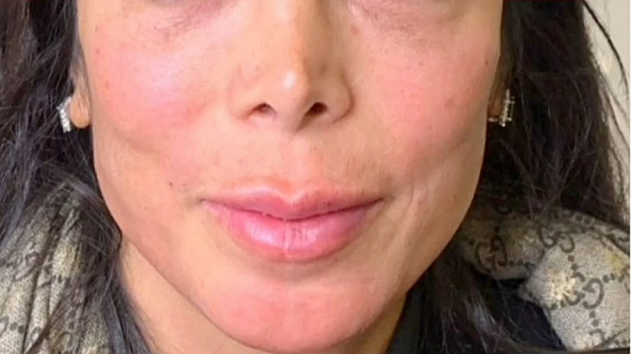 زاویه سازی صورت در کلینیک ایدن بلیچینگ دندان