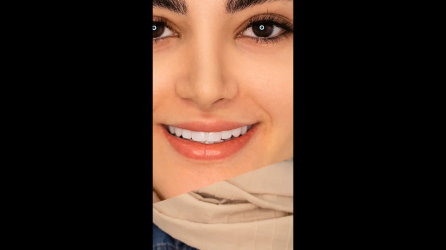 ارتودنسی دندان (ثابت) کامپوزیت دندان دکتر فرزاد ناصری متخصص ارتودنسی در اصفهان