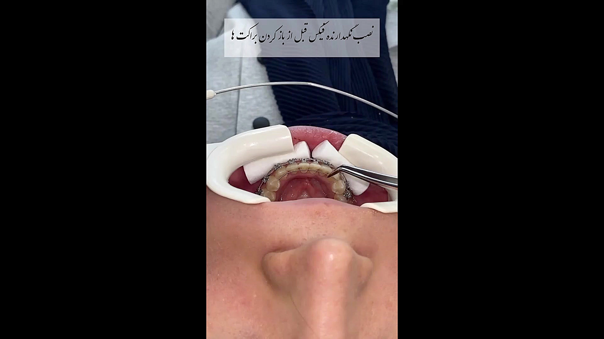 فیلم ارتودنسی ثابت فک پایین دکتر فرزاد ناصری متخصص ارتودنسی در اصفهان