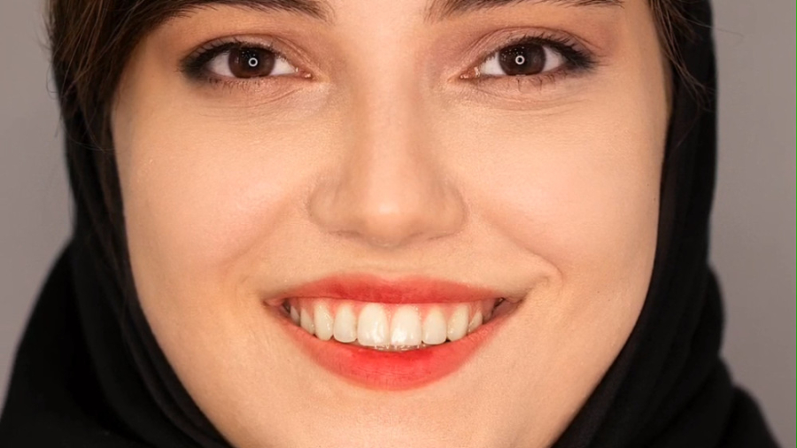 ارتودنسی ثابت برای اصلاح شیب و بهم ریختگی دکتر فرزاد ناصری متخصص ارتودنسی در اصفهان