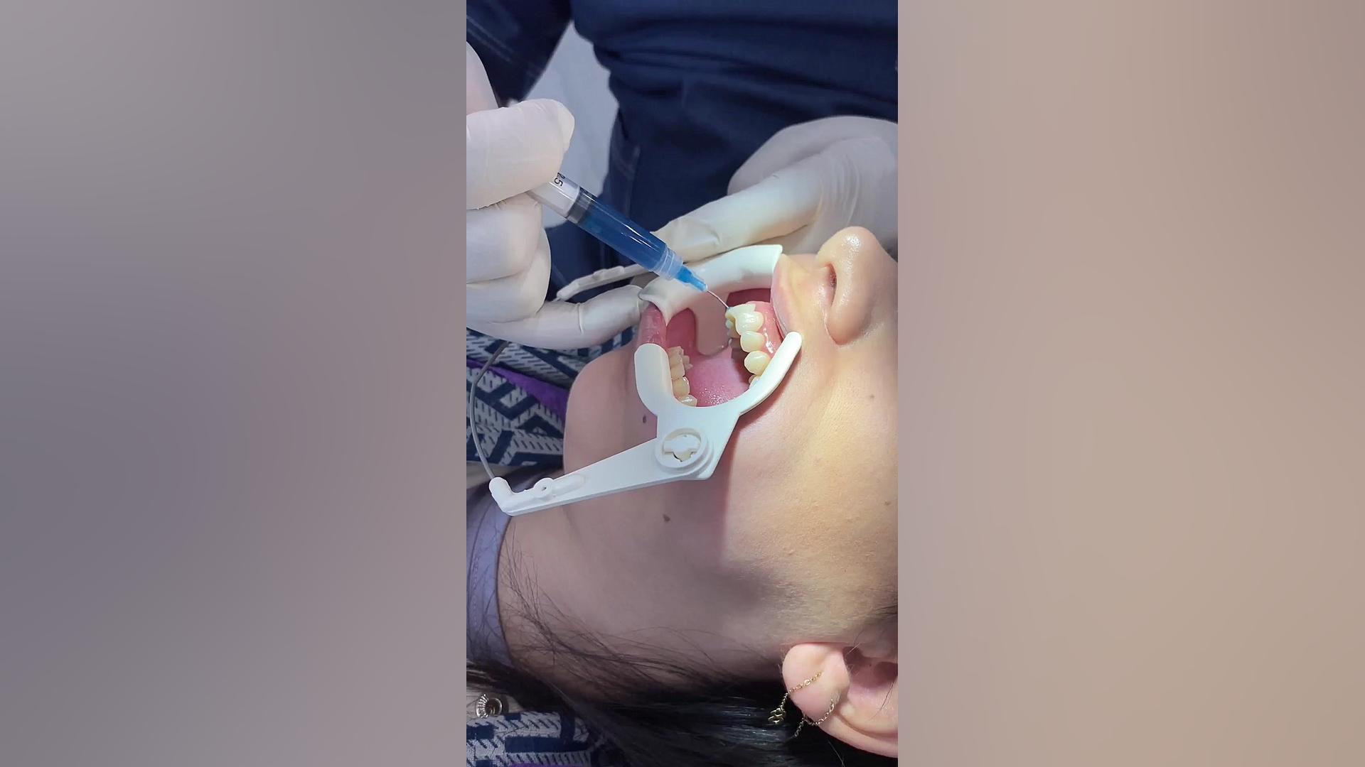 مراحل انجام ارتودنسی ثابت فک بالا دکتر فرزاد ناصری متخصص ارتودنسی در اصفهان