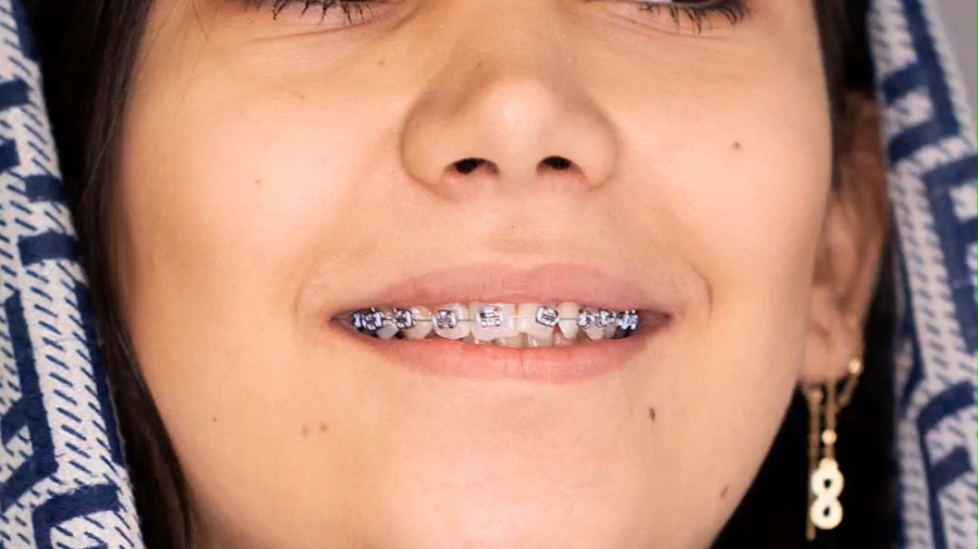 ارتودنسی ثابت یک فک دکتر فرزاد ناصری متخصص ارتودنسی در اصفهان